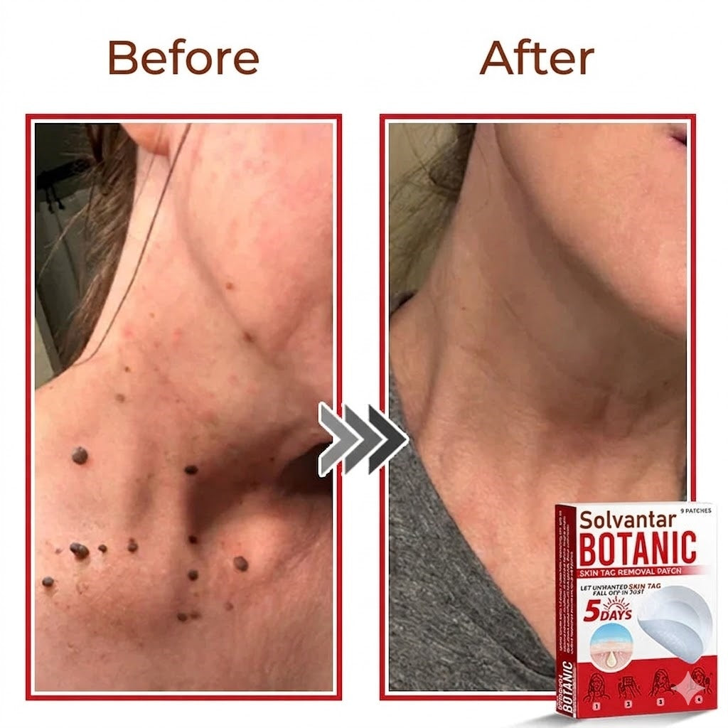 🌈Solvantar MicroNeedle Botanic Skin Tag Removal Patch 🇺🇸 Made in the USA