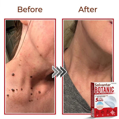 🌈Solvantar MicroNeedle Botanic Skin Tag Removal Patch 🇺🇸 Made in the USA