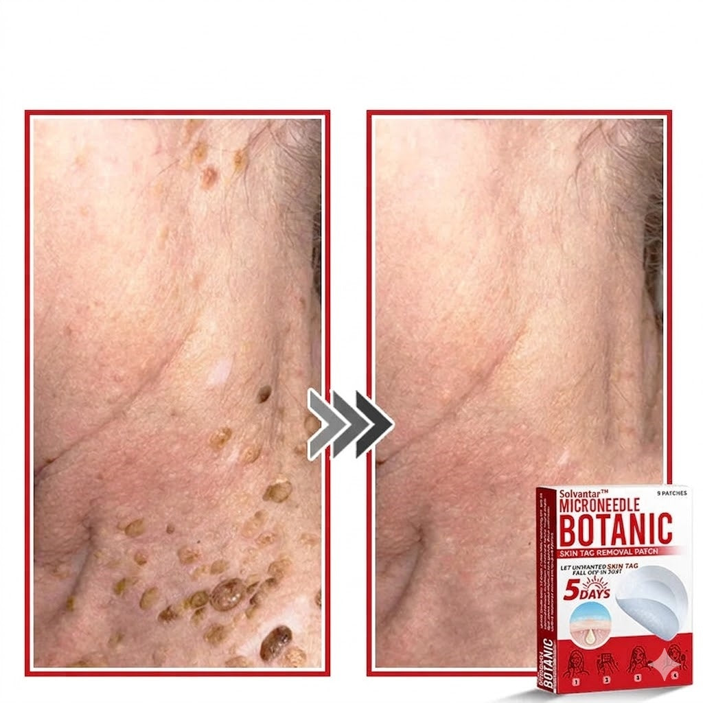 🌈Solvantar MicroNeedle Botanic Skin Tag Removal Patch 🇺🇸 Made in the USA