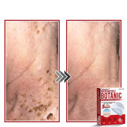 🌈Solvantar MicroNeedle Botanic Skin Tag Removal Patch 🇺🇸 Made in the USA