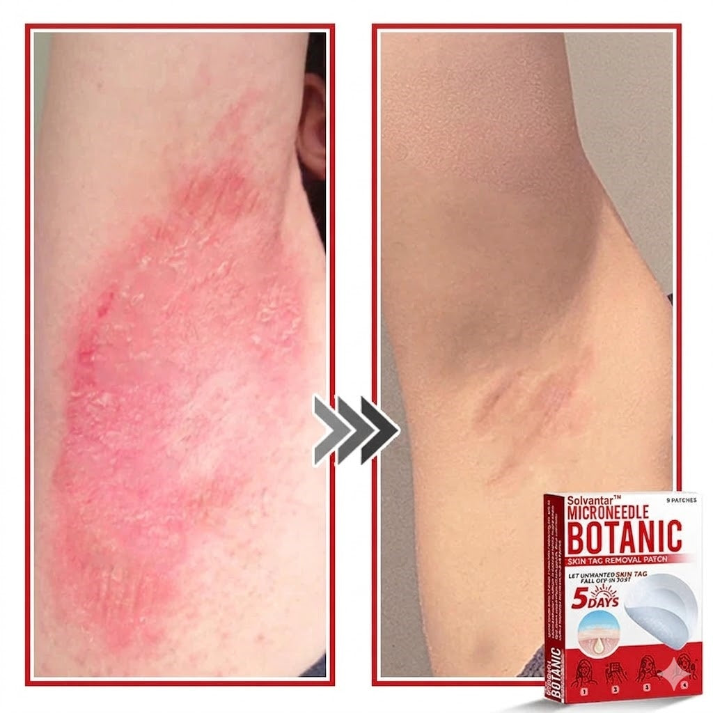 🌈Solvantar MicroNeedle Botanic Skin Tag Removal Patch 🇺🇸 Made in the USA