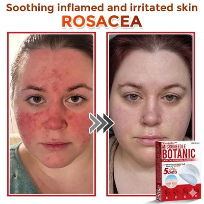 🌈Solvantar MicroNeedle Botanic Skin Tag Removal Patch 🇺🇸 Made in the USA