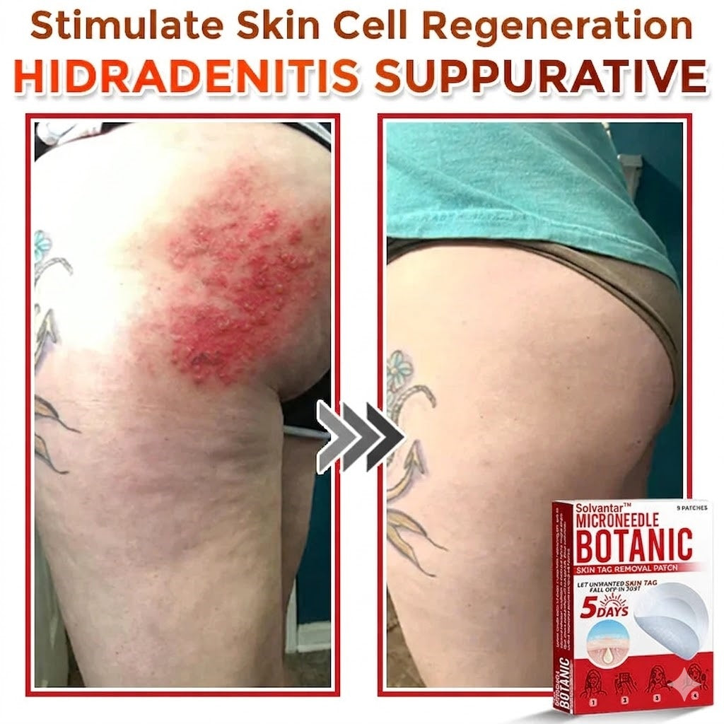 🌈Solvantar MicroNeedle Botanic Skin Tag Removal Patch 🇺🇸 Made in the USA