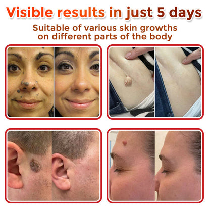 🌈Solvantar MicroNeedle Botanic Skin Tag Removal Patch 🇺🇸 Made in the USA